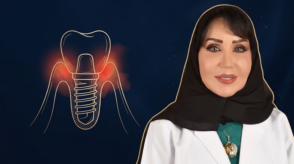 التهاب اللثة حول تركيبات الزرعات